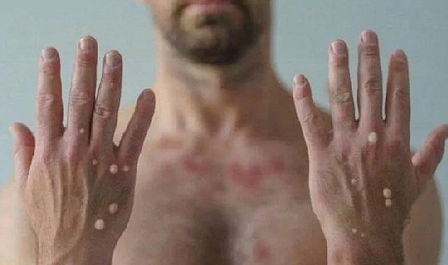 KKTC&#039;de maymun çiçeği virüsü