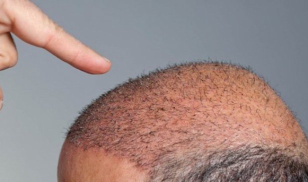 Saç ekimi zararlı mı? Ekilen saç ne kadar sürede uzar? Saç ekimi sonrası dökülme nasıl olur? Saç ekimi nasıl yapılır? Saç ektirmek günah mı?