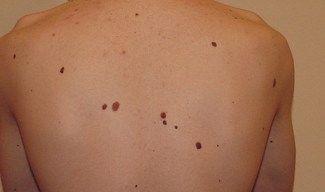 Vücudumuzda Oluşan Benler Ne Anlama Geliyor?