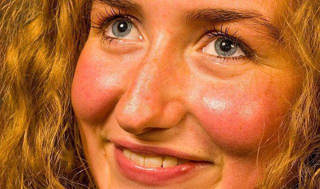 Yüzümüz Neden Kızarır?