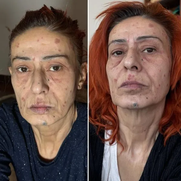 Yıldız Tilbe ve kimyasal yanık skandalında flaş gelişme