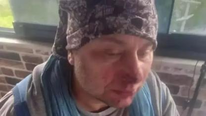 Onur Akay Entübe Edildi! Pitbull Saldırısı Sonrası 'Et Yiyen Bakteri' Kabusu